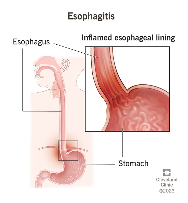 10138 esophagitis