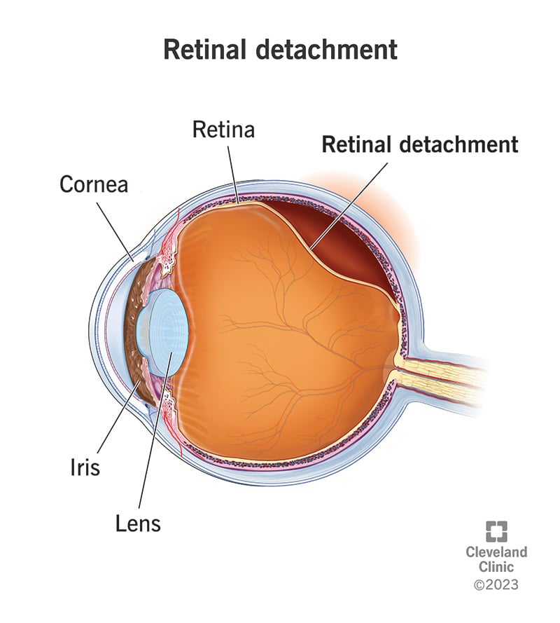 10705 retinal detachment