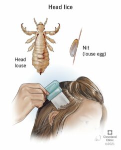 10824 head lice