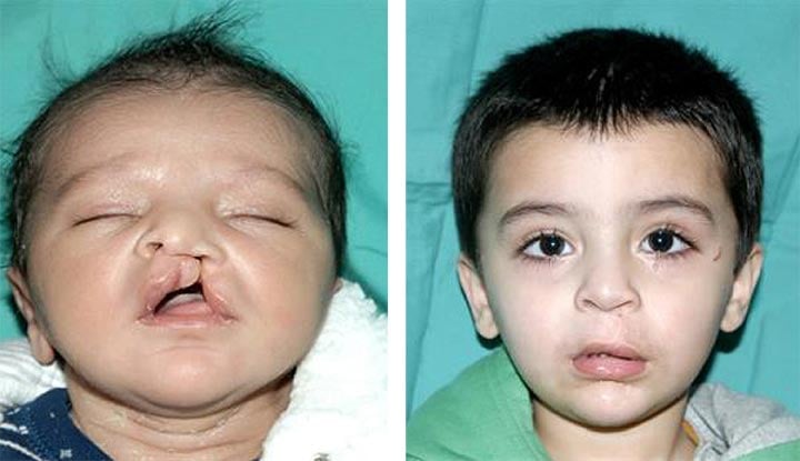 10947 cleft lip cleft palate
