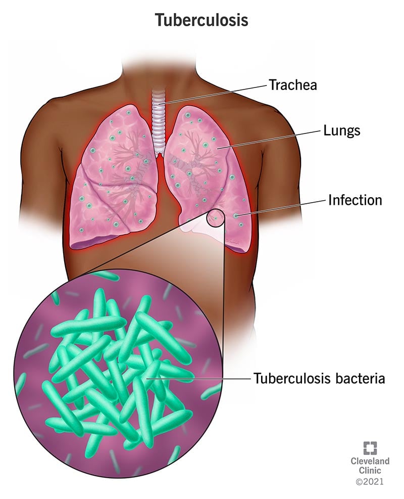 11301 tuberculosis
