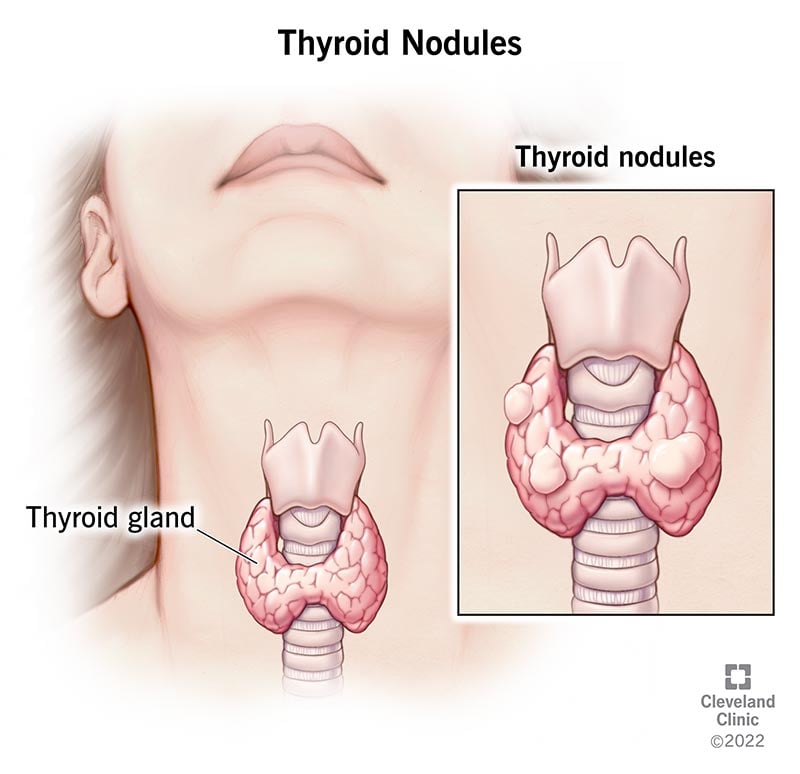 13121 thyroid nodules illustration