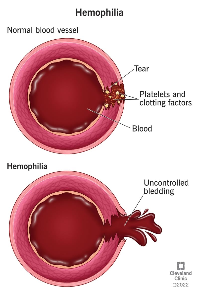 Hüübimisfaktorid on teie veres olevad valgud, mis töötavad koos teie trombotsüütidega (ülemine) verejooksu peatamiseks või aeglustamiseks.