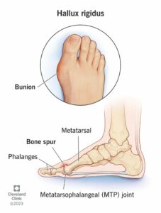 14665 hallux rigidus