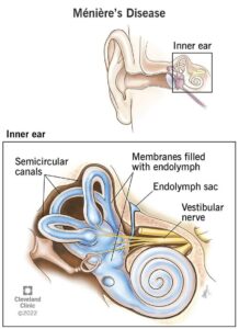 15167 menieres disease