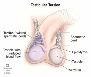 15382 testicular torsion