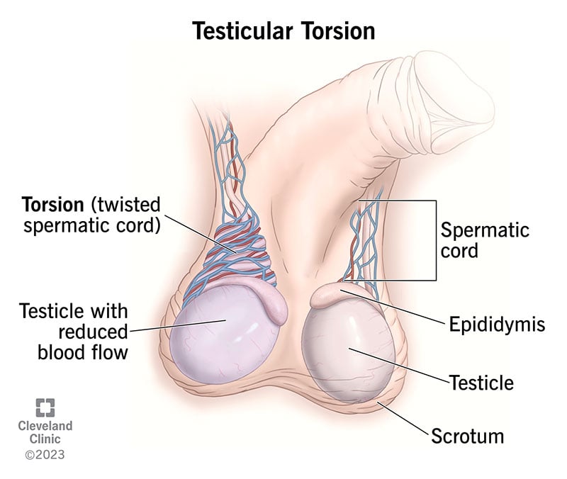 15382 testicular torsion