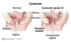 15468 cystocele