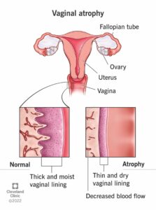 15500 vaginal atrophy