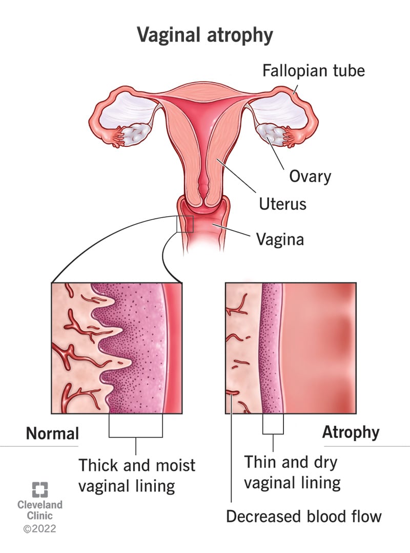 Labia Majora Atrophy Labial Hypertrophy Symptoms Treatment And 