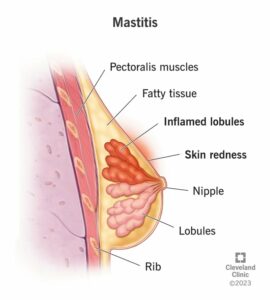 15613 mastitis