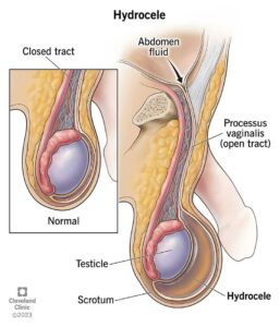 16294 hydrocele