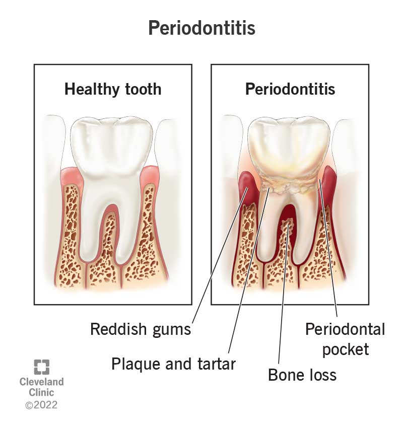 16620 periodontitis
