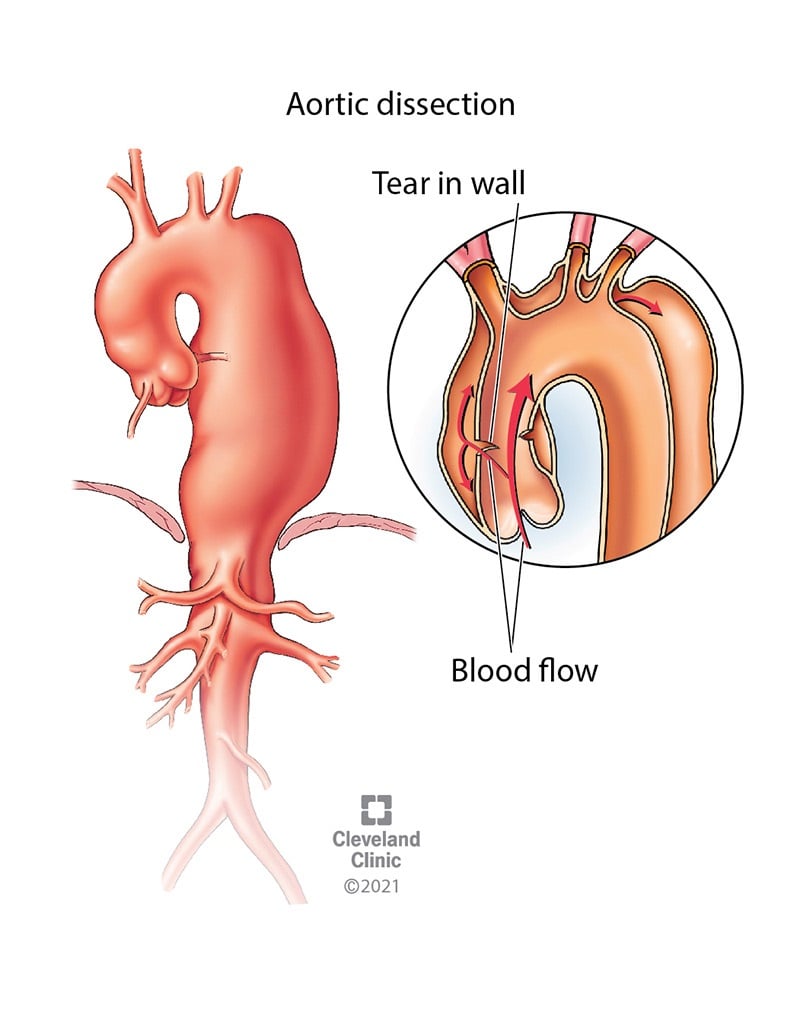 Aordi dissektsioon on aordi seina sisemise kihi rebend.  Veri voolab läbi pisara, põhjustades seinakihtide eraldumist, arteri väljapaistmist ja nõrkust selles aordi piirkonnas.