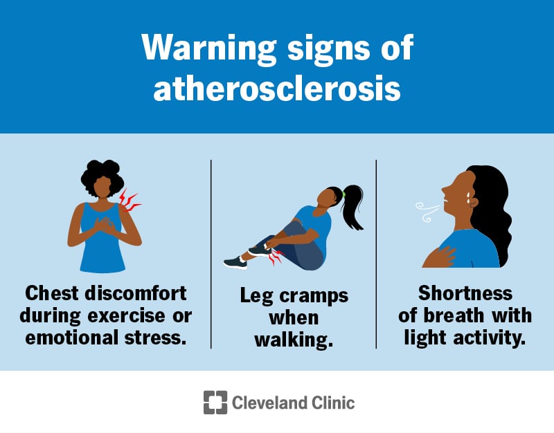 Infograafik, mis näitab mitmeid ateroskleroosi hoiatusmärke.  Nende hulka kuuluvad ebamugavustunne rinnus treeningu ajal või emotsionaalne stress, jalakrambid kõndimisel ja õhupuudus kerge tegevusega.