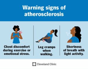 16753 atherosclerosis.ashx