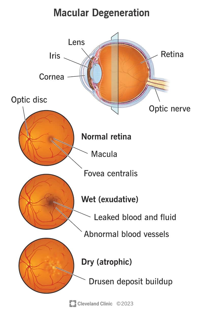 Märg (eksudatiivne) kollatähni degeneratsioon põhjustab teie silma võrkkestas täiendavaid veresooni ja vere lekkimist, samas kui kuiv (atroofiline) kollatähni degeneratsioon põhjustab druseeni ladestumist.