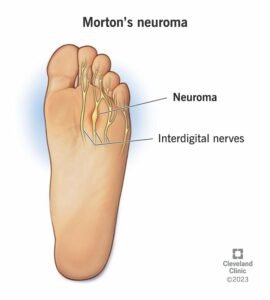 1699078130 491 15118 mortons neuroma