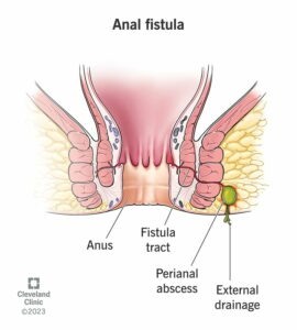 1699294792 825 14466 anal fistula