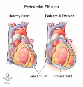 17351 pericardial effusion