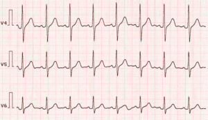 17616 normal ekg