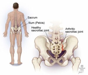 17736 sacroiliitis