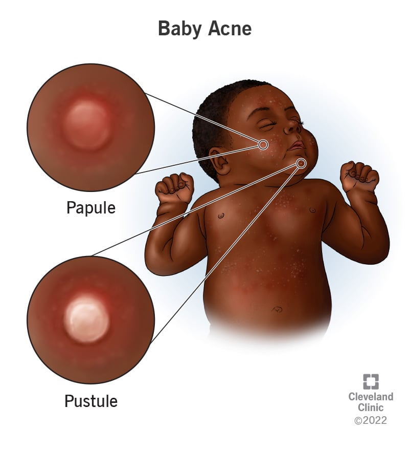 17822 baby acne