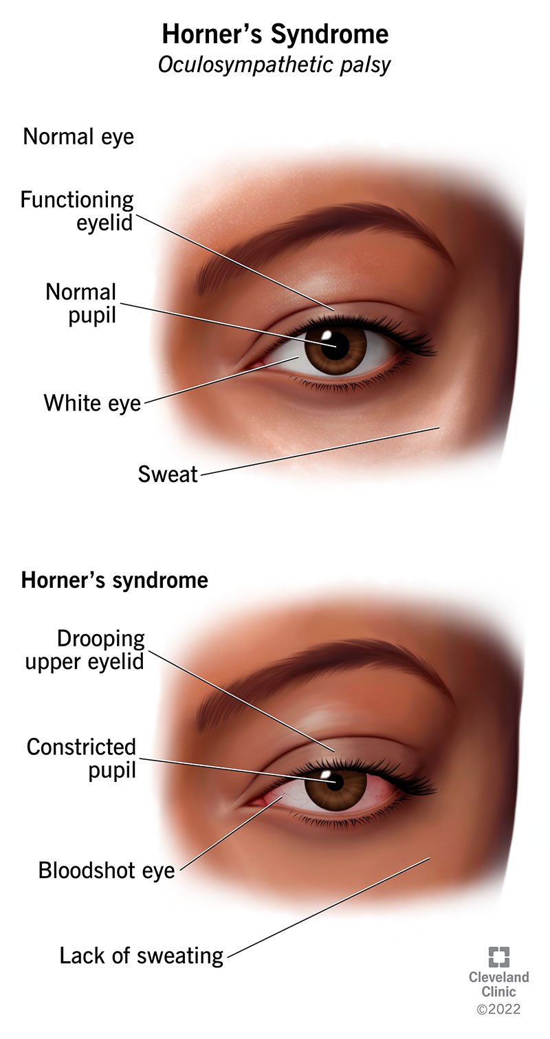 Horneri sündroomi sümptomiteks on rippuv ülemine silmalaud, pupillide kokkutõmbumine, verine silm ja vähene higistamine kahjustatud piirkonnas.