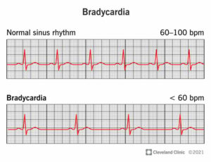 17841 bradycardia