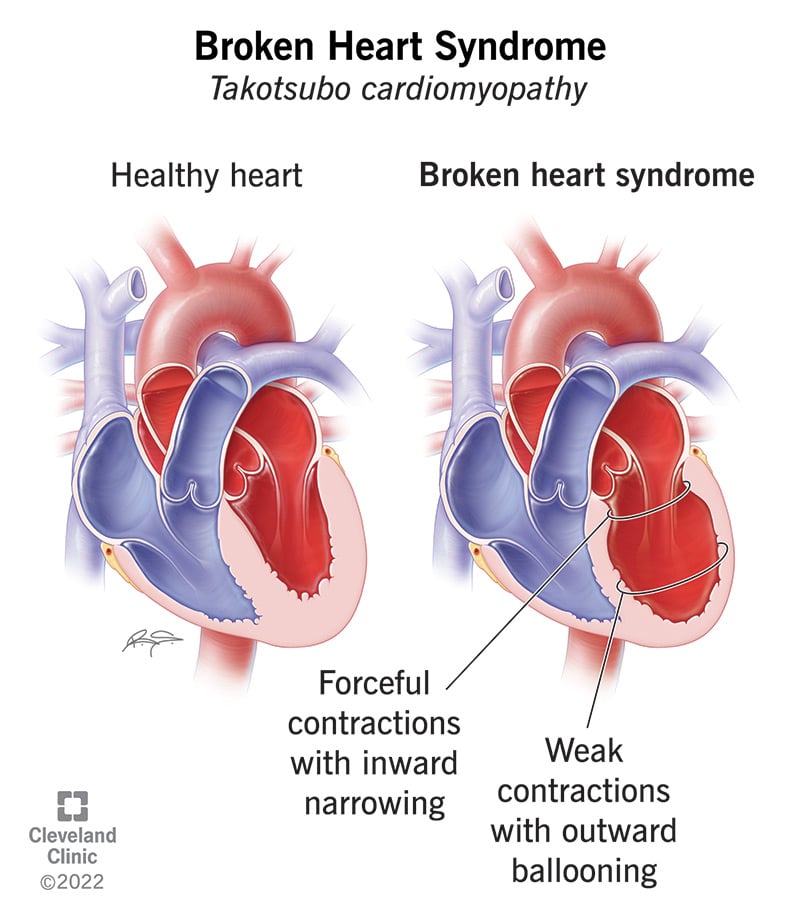 17857 broken heart syndrome illustration