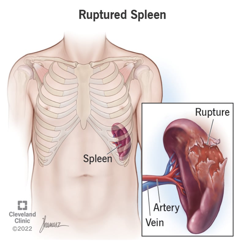 17953 ruptured spleen