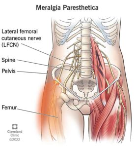 17959 meralgia paresthetica