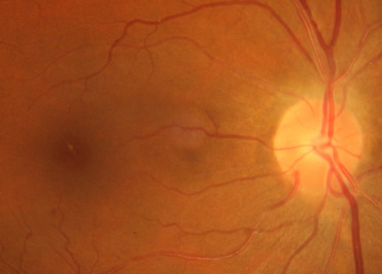 19 HEYE 1952 Hypertensive Retinopathy