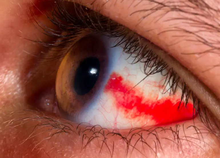 19 HEYE 1952 Subconjunctive Hemorrhage