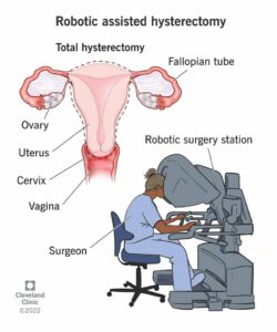 21057 robotic assisted hysterectomy