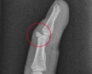 21802 avulsion fracture