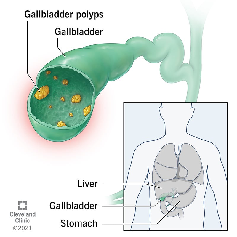 Sapipõie polüübid on kasvajad teie sapipõie sisemisel voodril.  Sapipõis on seedesüsteemi organ.