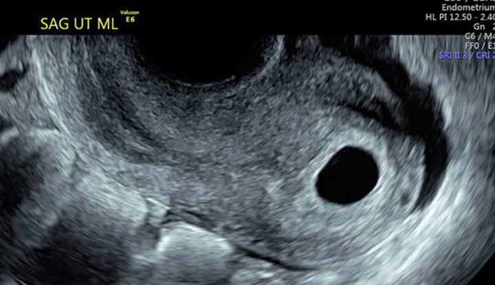Tühja raseduskotti või kahjustatud munaraku ultraheli.