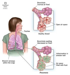 21954 aspiration pneumonia