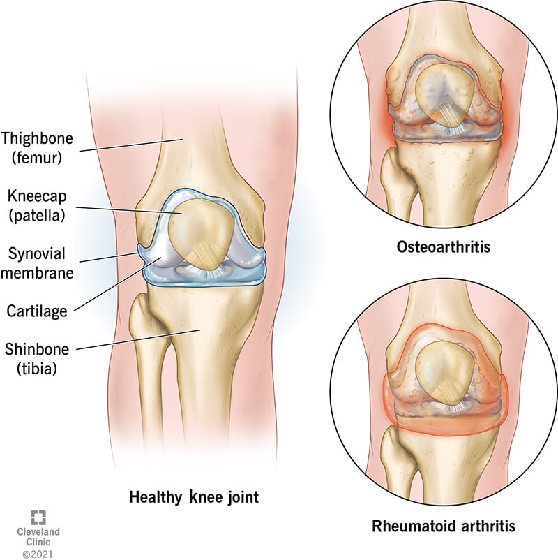 21978 arthritis of the knee