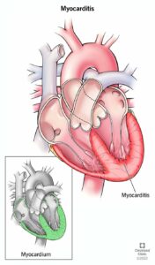 22129 myocarditis