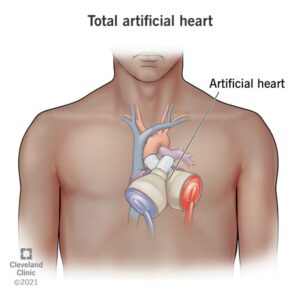 22173 total artificial heart illustration