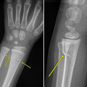 22235 buckle fracture