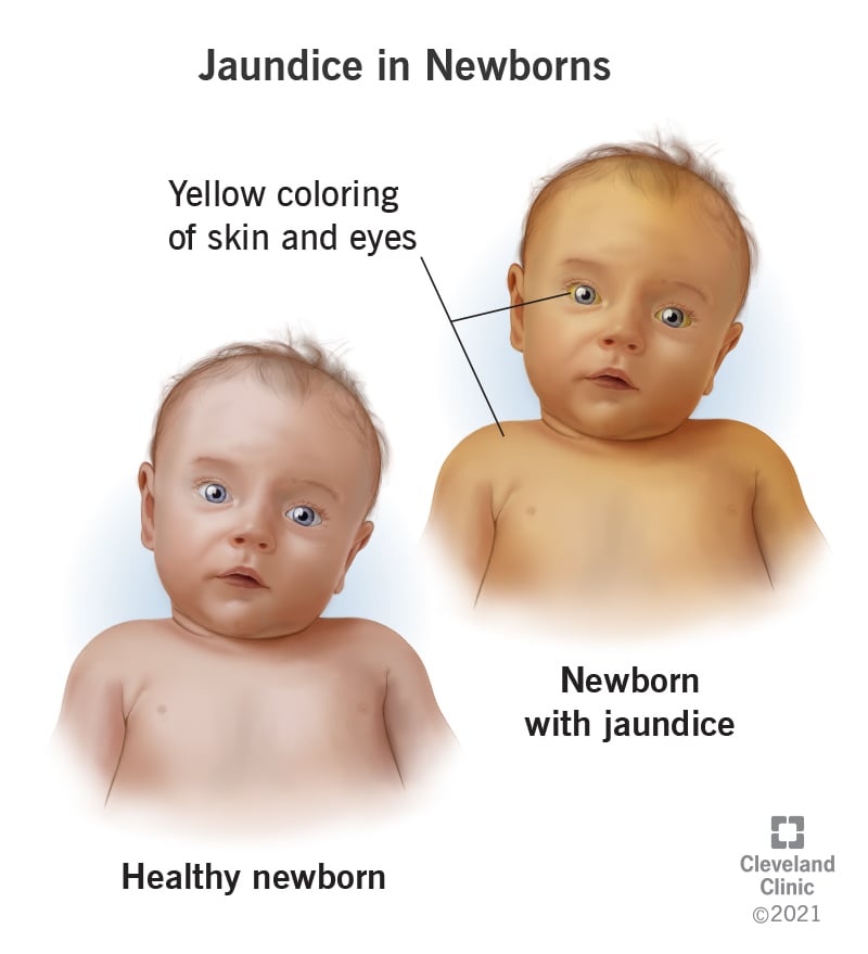 22263 jaudince in newborns