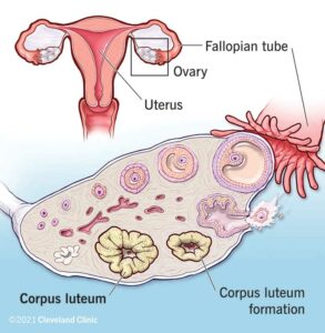 22340 corpus luteum cyst