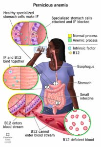 22377 pernicious anemia