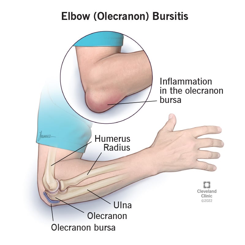 22553 elbow olecranon bursitis