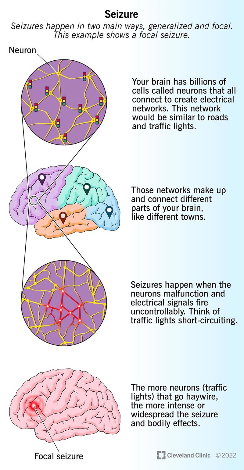 Teie aju koosneb neuronite võrkudest, mis saadavad ja edastavad elektrilisi signaale.  Krambid häirivad nende signaalide voogu.