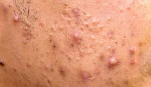 22905 acne papules