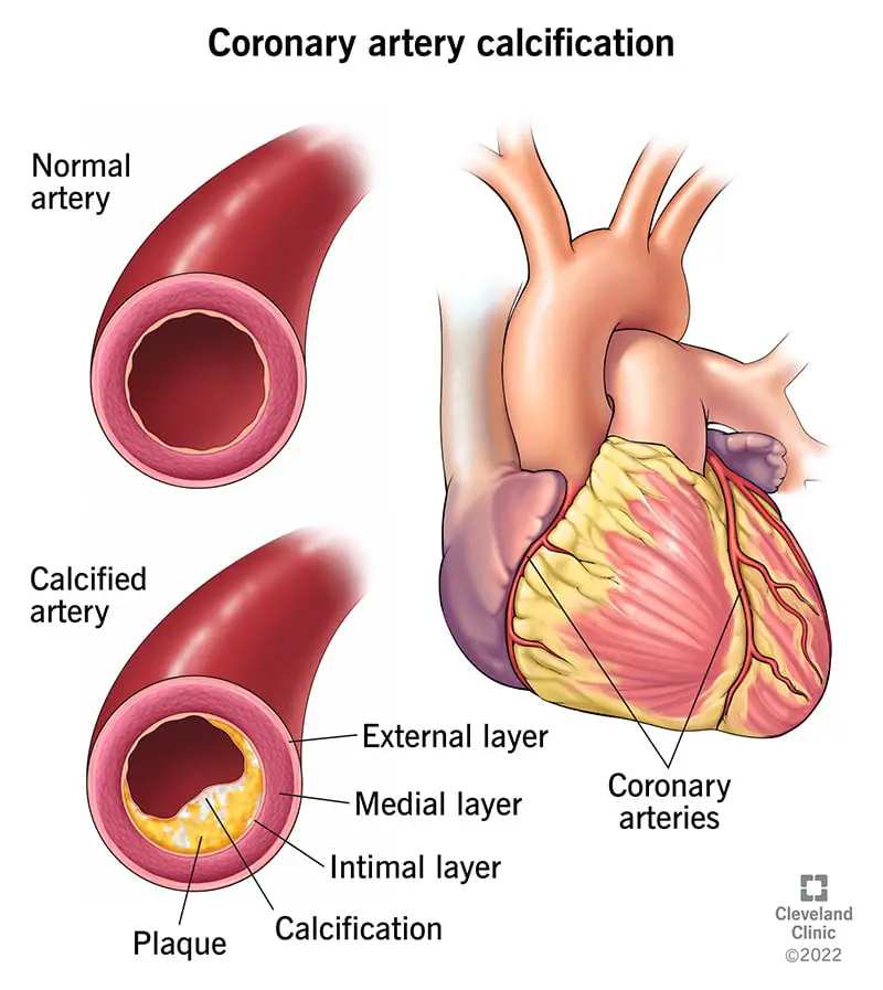 22953 coronary artery calcification